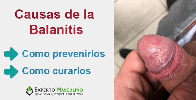 causas de la balanitis y como evitarlo